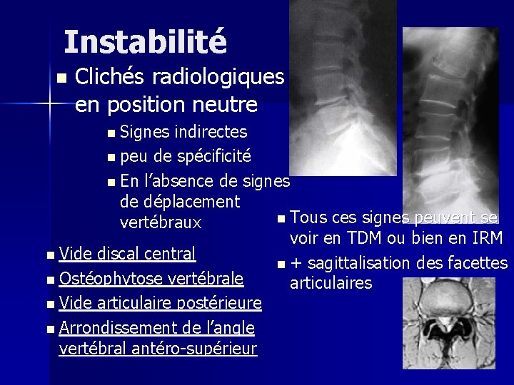 Instabilité n Clichés radiologiques en position neutre n Signes indirectes n peu de spécificité