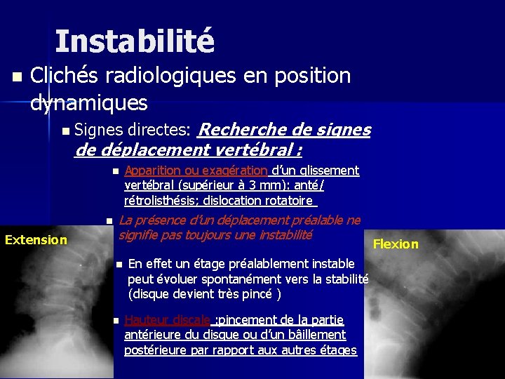 Instabilité n Clichés radiologiques en position dynamiques n Signes directes: Recherche de signes de
