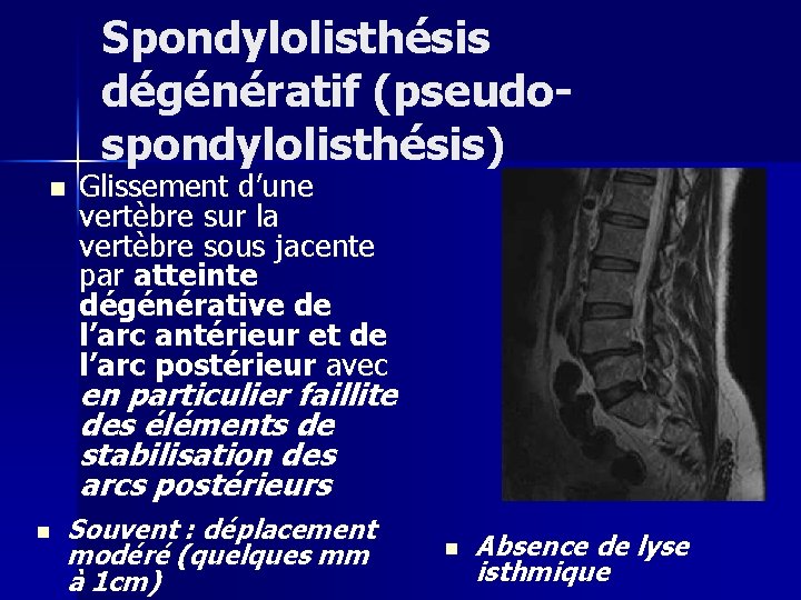 Spondylolisthésis dégénératif (pseudospondylolisthésis) n Glissement d’une vertèbre sur la vertèbre sous jacente par atteinte