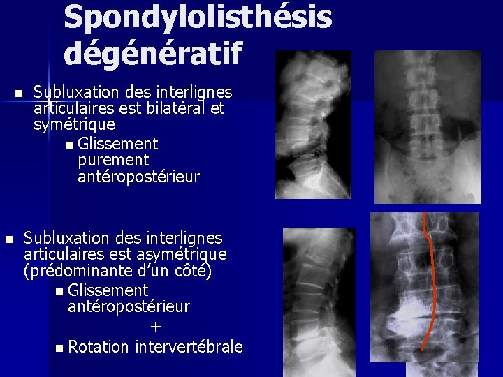 Spondylolisthésis dégénératif n n Subluxation des interlignes articulaires est bilatéral et symétrique n Glissement