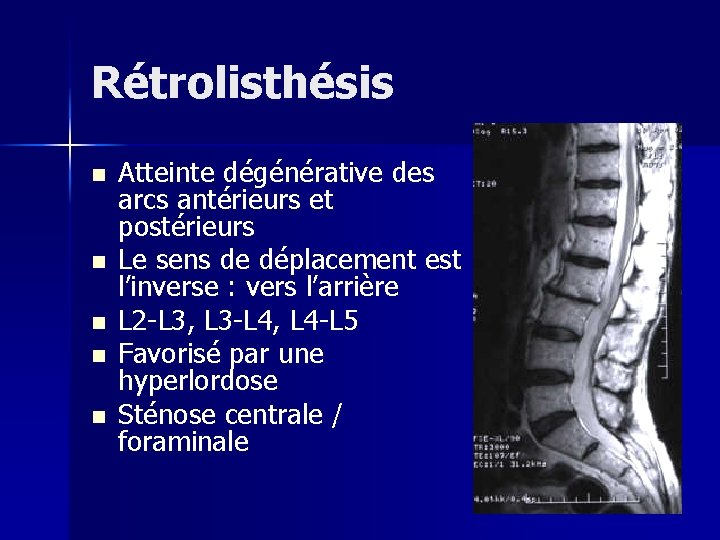 Rétrolisthésis n n n Atteinte dégénérative des arcs antérieurs et postérieurs Le sens de