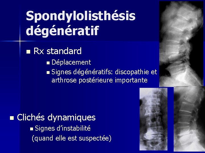 Spondylolisthésis dégénératif n Rx standard n Déplacement n Signes dégénératifs: discopathie et surtout arthrose