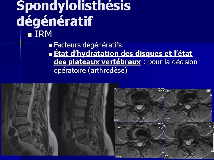 Spondylolisthésis dégénératif n IRM n Facteurs dégénératifs n État d’hydratation des disques et l’état