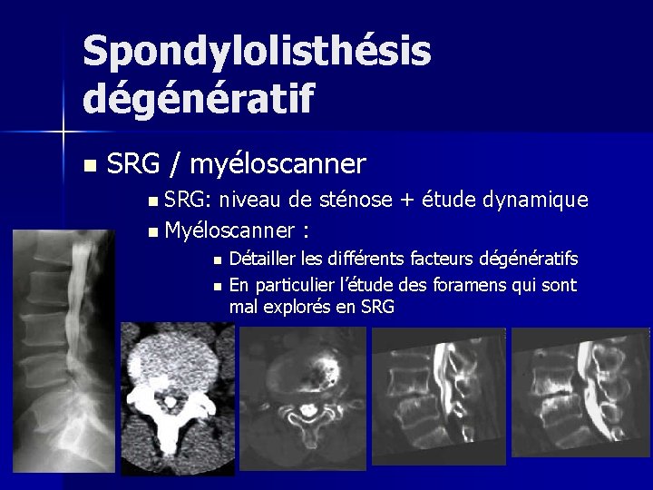 Spondylolisthésis dégénératif n SRG / myéloscanner n SRG: niveau de sténose + étude dynamique