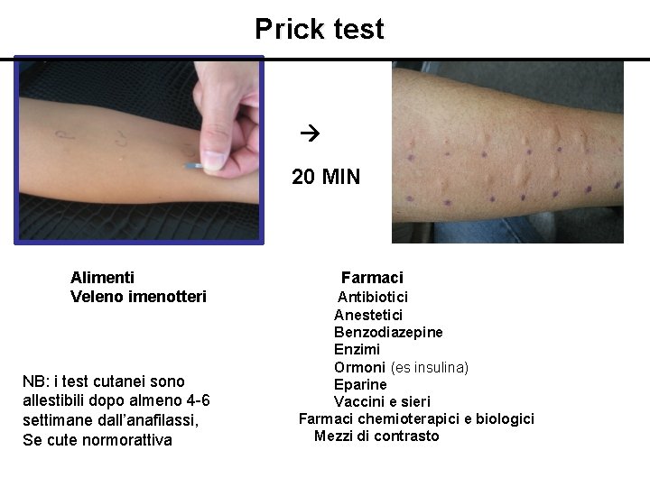 Prick test 20 MIN Alimenti Veleno imenotteri NB: i test cutanei sono allestibili dopo