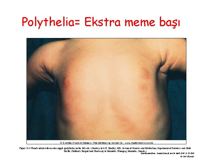 Polythelia= Ekstra meme başı Figure 19 -9 Female infant with an extra nipple (polythelia)