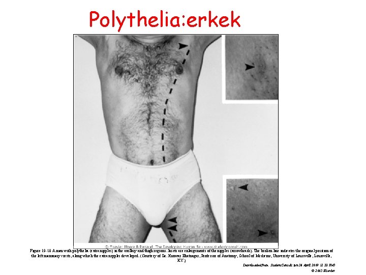 Polythelia: erkek Figure 19 -10 A man with polythelia (extra nipples) in the axillary