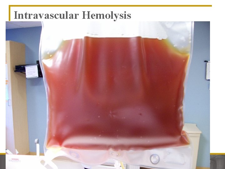 Intravascular Hemolysis Page 18 