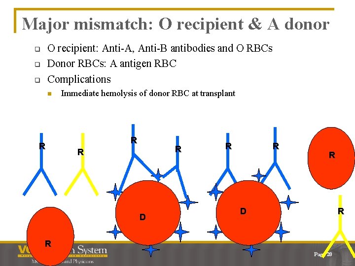 Major mismatch: O recipient & A donor O recipient: Anti-A, Anti-B antibodies and O
