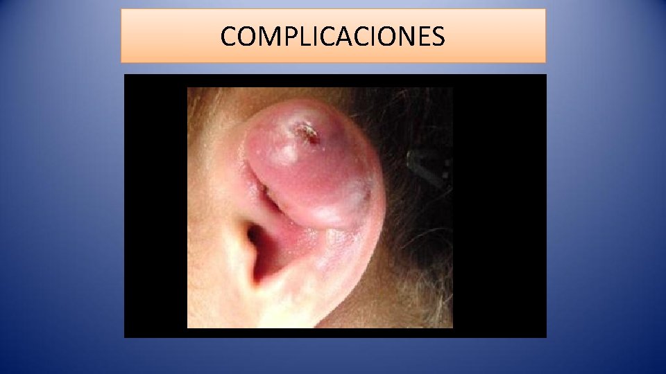 COMPLICACIONES 