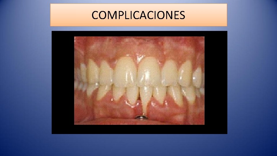 COMPLICACIONES 