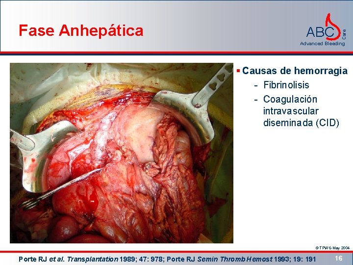 ABC Care Fase Anhepática Advanced Bleeding § Causas de hemorragia - Fibrinolisis - Coagulación