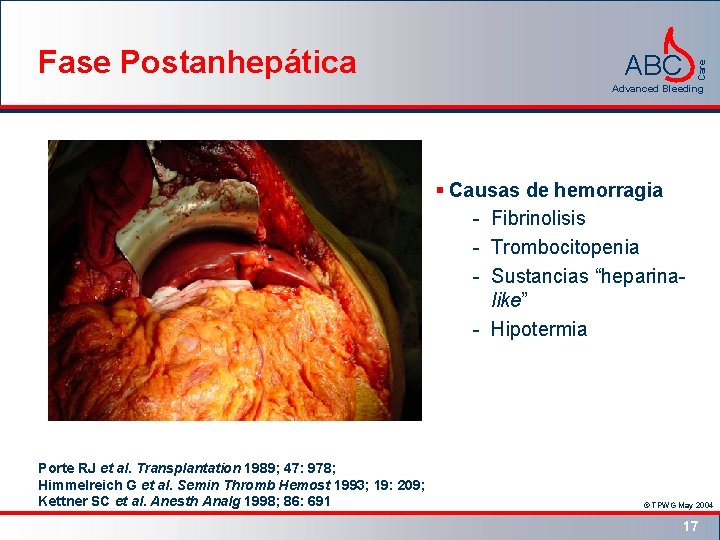 ABC Care Fase Postanhepática Advanced Bleeding § Causas de hemorragia - Fibrinolisis - Trombocitopenia