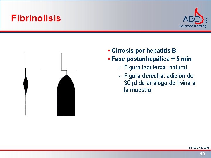 ABC Care Fibrinolisis Advanced Bleeding § Cirrosis por hepatitis B § Fase postanhepática +