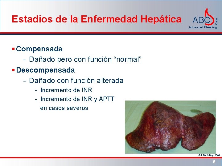 ABC Care Estadios de la Enfermedad Hepática Advanced Bleeding § Compensada - Dañado pero