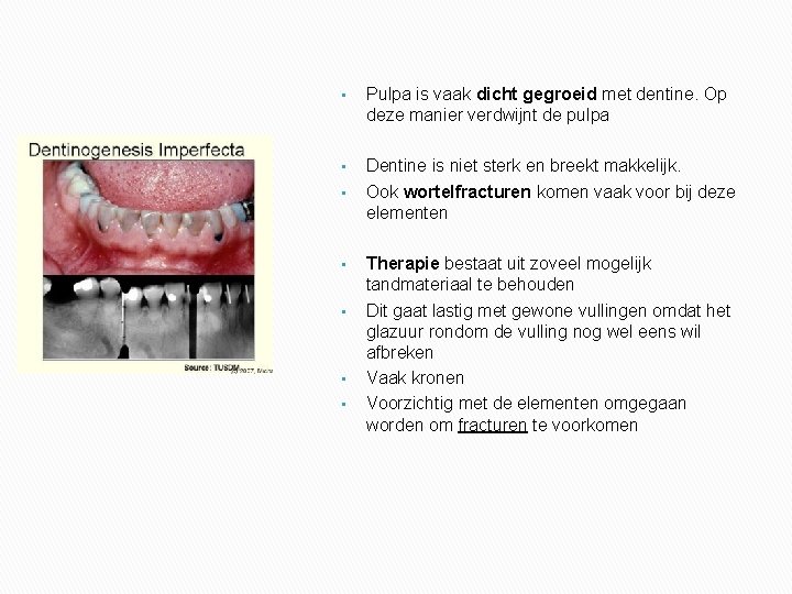  • Pulpa is vaak dicht gegroeid met dentine. Op deze manier verdwijnt de