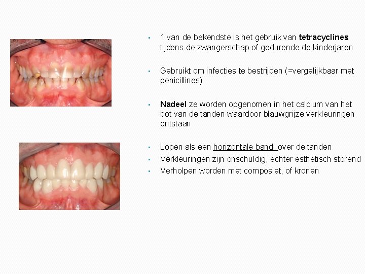  • 1 van de bekendste is het gebruik van tetracyclines tijdens de zwangerschap