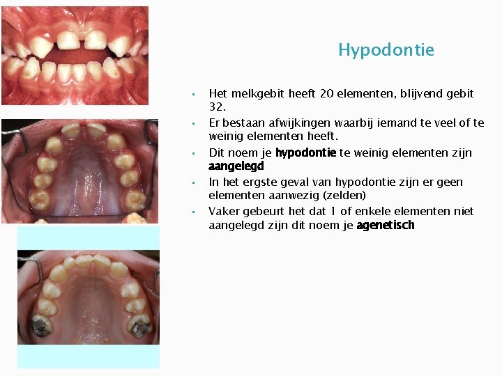 Hypodontie • • • Het melkgebit heeft 20 elementen, blijvend gebit 32. Er bestaan