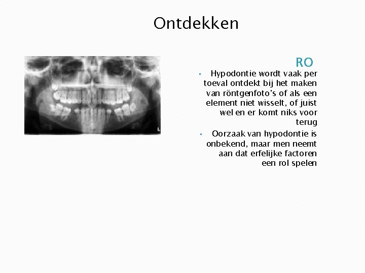 Ontdekken RO Hypodontie wordt vaak per toeval ontdekt bij het maken van röntgenfoto’s of