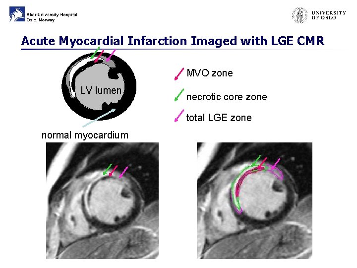 Acute Myocardial Infarction Imaged with LGE CMR MVO zone LV lumen necrotic core zone