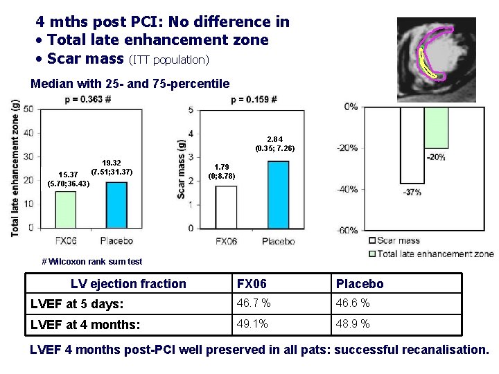 4 mths post PCI: No difference in • Total late enhancement zone • Scar