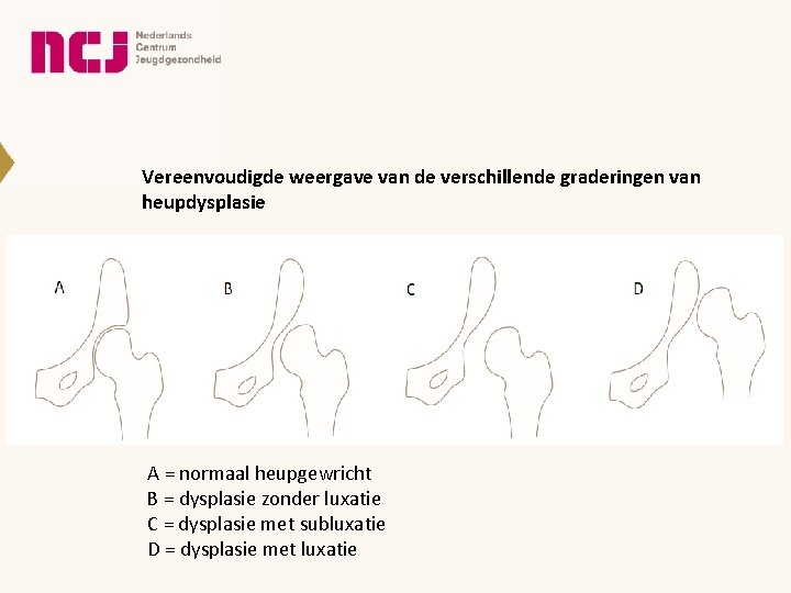 Vereenvoudigde weergave van de verschillende graderingen van heupdysplasie A = normaal heupgewricht B =