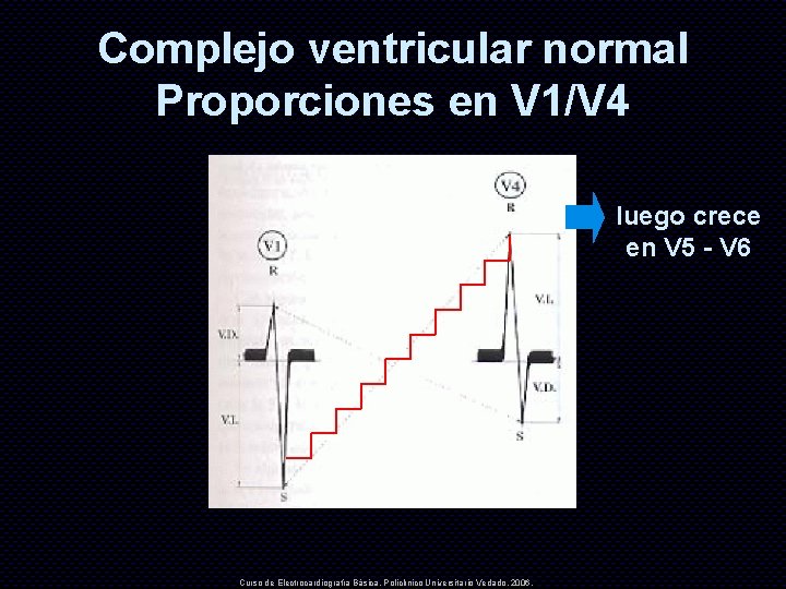 Complejo ventricular normal Proporciones en V 1/V 4 luego crece en V 5 -