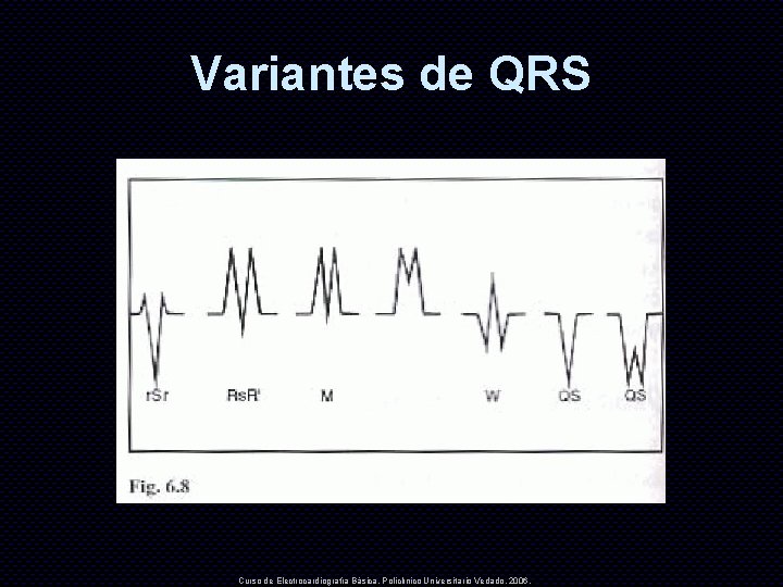 Variantes de QRS Curso de Electrocardiografía Básica. Policlínico Universitario Vedado. 2006. 