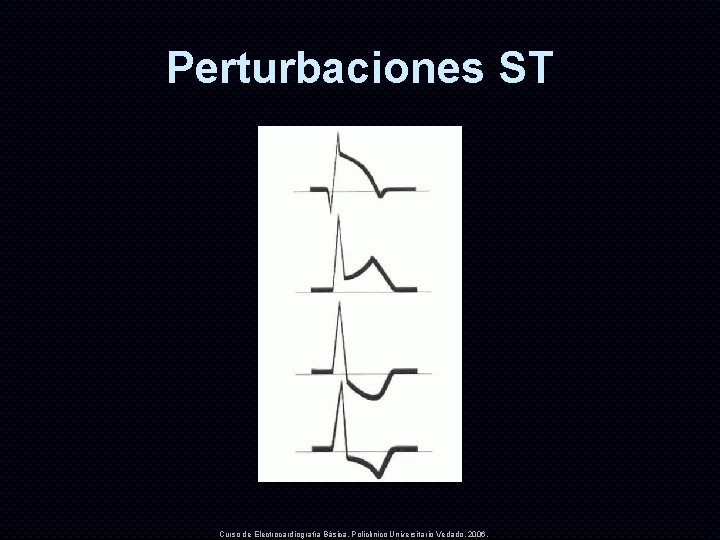 Perturbaciones ST Curso de Electrocardiografía Básica. Policlínico Universitario Vedado. 2006. 