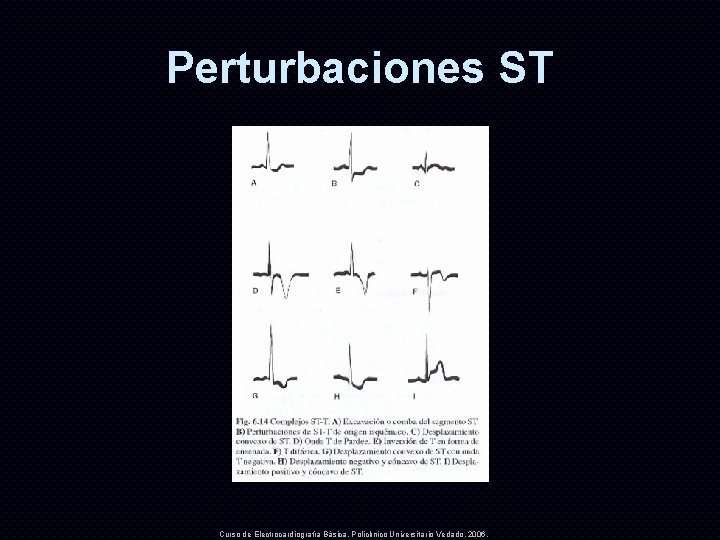 Perturbaciones ST Curso de Electrocardiografía Básica. Policlínico Universitario Vedado. 2006. 