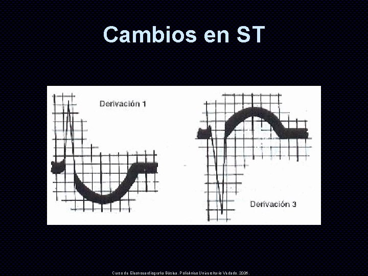 Cambios en ST Curso de Electrocardiografía Básica. Policlínico Universitario Vedado. 2006. 