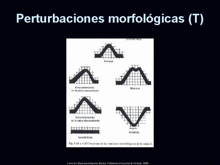 Perturbaciones morfológicas (T) Curso de Electrocardiografía Básica. Policlínico Universitario Vedado. 2006. 