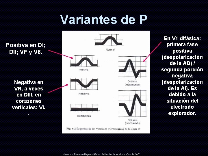 Variantes de P En V 1 difásica: primera fase positiva (despolarización de la AD)