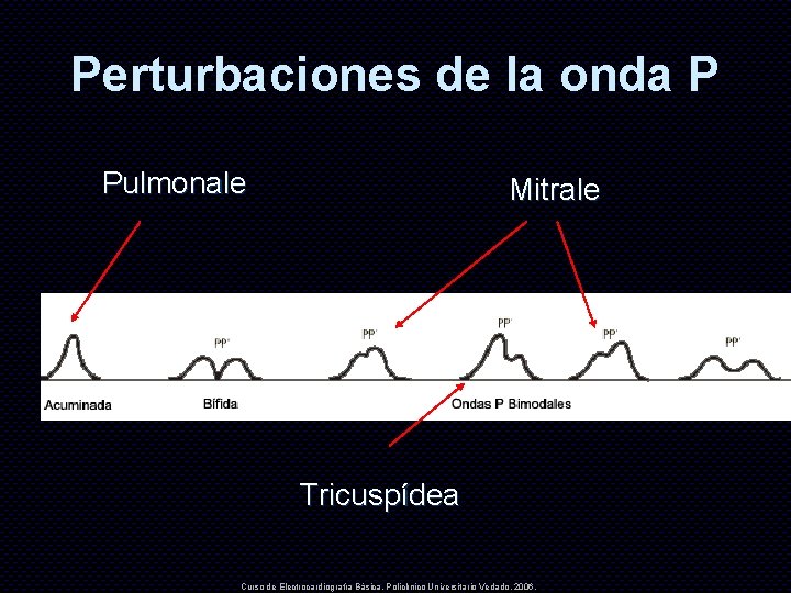 Perturbaciones de la onda P Pulmonale Mitrale Tricuspídea Curso de Electrocardiografía Básica. Policlínico Universitario