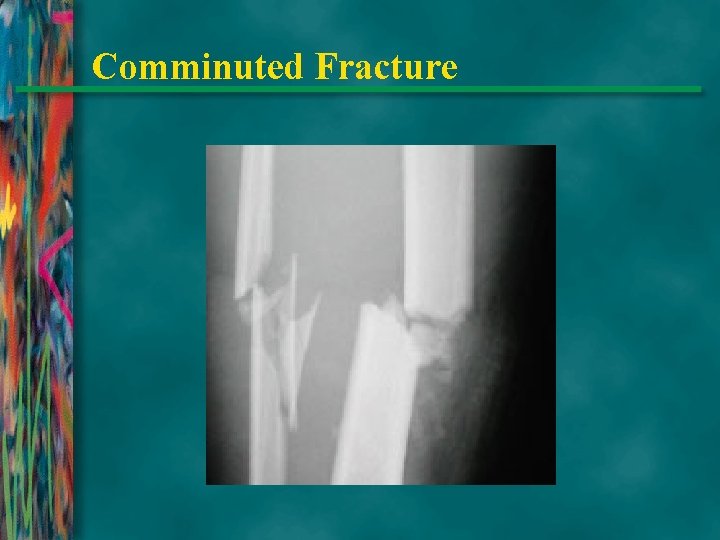 Comminuted Fracture 