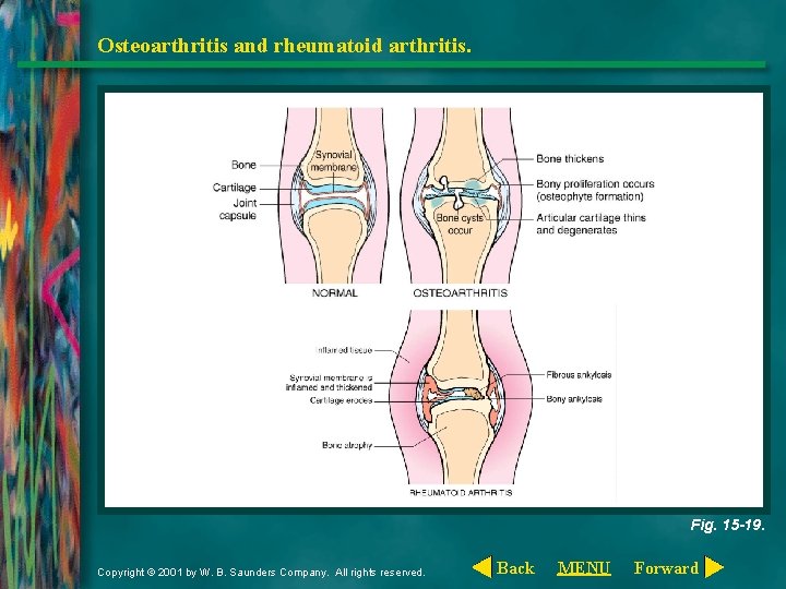 Osteoarthritis and rheumatoid arthritis. Fig. 15 -19. Copyright © 2001 by W. B. Saunders