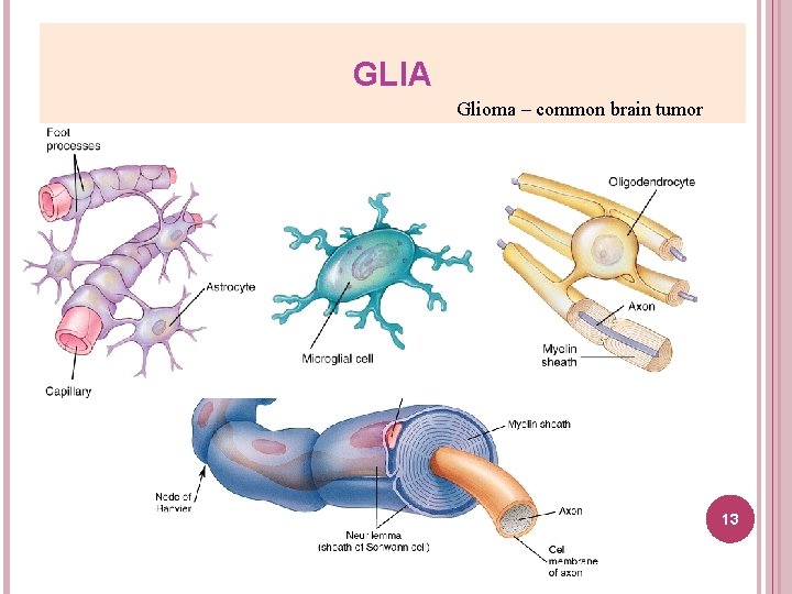 GLIA Glioma – common brain tumor 13 