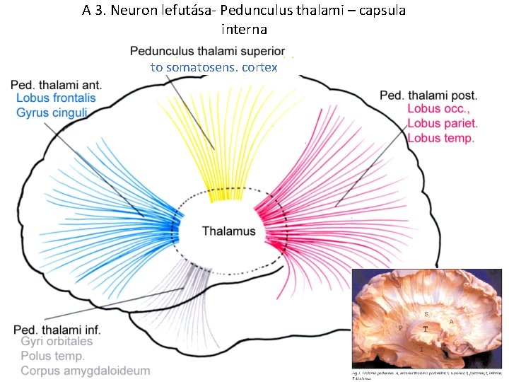 A 3. Neuron lefutása- Pedunculus thalami – capsula interna to somatosens. cortex 