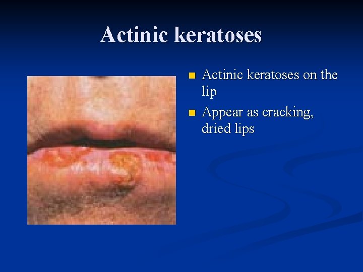 Actinic keratoses n n Actinic keratoses on the lip Appear as cracking, dried lips