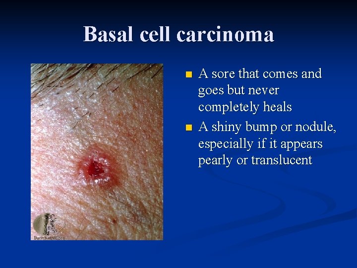 Basal cell carcinoma n n A sore that comes and goes but never completely