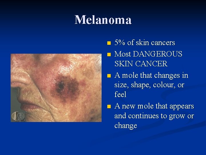 Melanoma n n 5% of skin cancers Most DANGEROUS SKIN CANCER A mole that