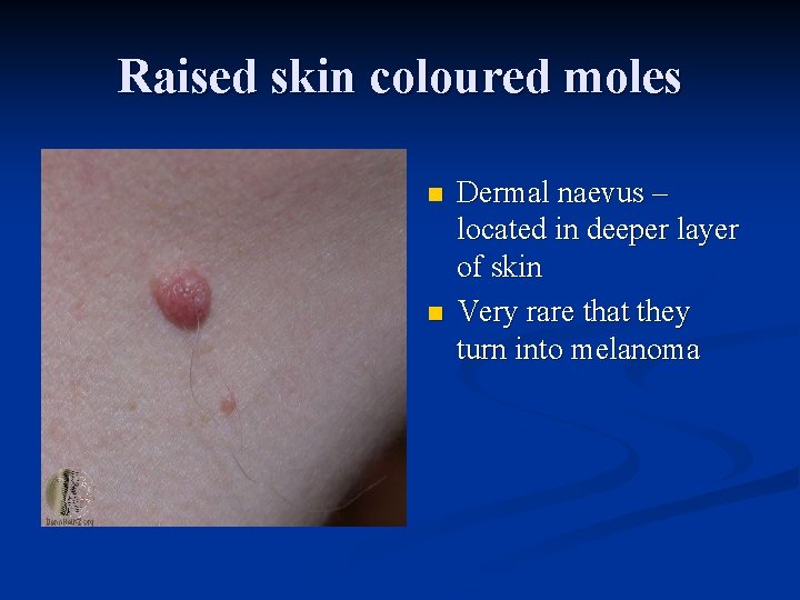 Raised skin coloured moles n n Dermal naevus – located in deeper layer of