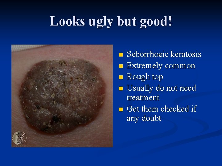 Looks ugly but good! n n n Seborrhoeic keratosis Extremely common Rough top Usually