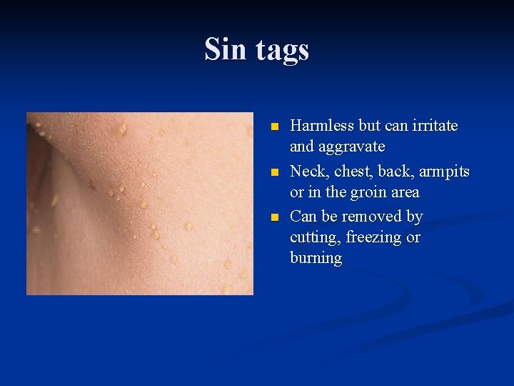 Sin tags n n n Harmless but can irritate and aggravate Neck, chest, back,