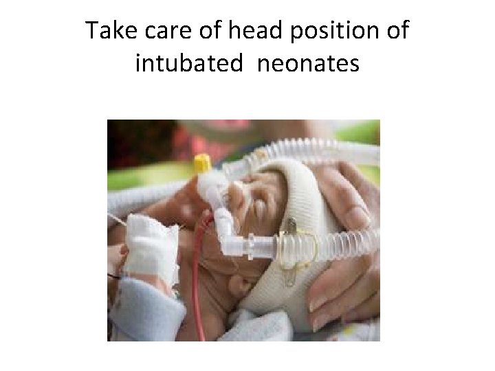 Take care of head position of intubated neonates 