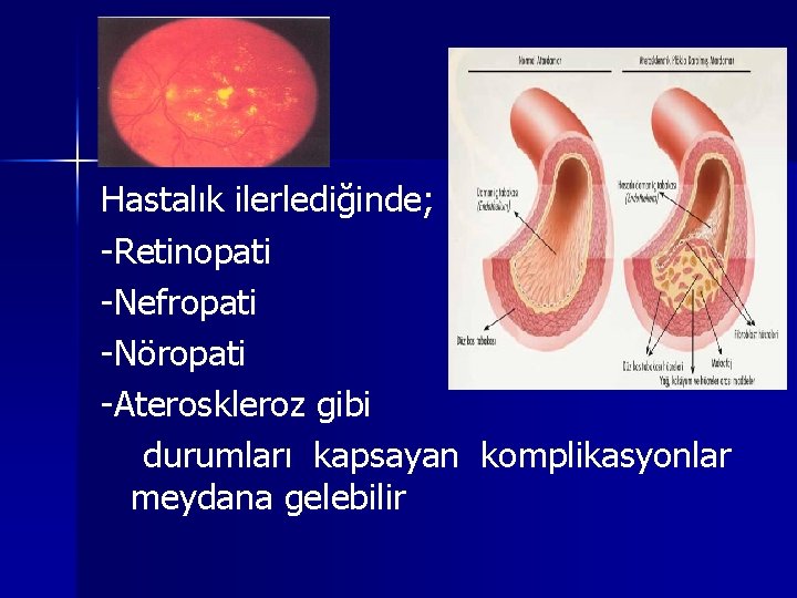 Hastalık ilerlediğinde; -Retinopati -Nefropati -Nöropati -Ateroskleroz gibi durumları kapsayan komplikasyonlar meydana gelebilir Hastalık ilerlediğinde; -Retinopati -Nefropati -Nöropati -Ateroskleroz gibi durumları kapsayan komplikasyonlar meydana gelebilir