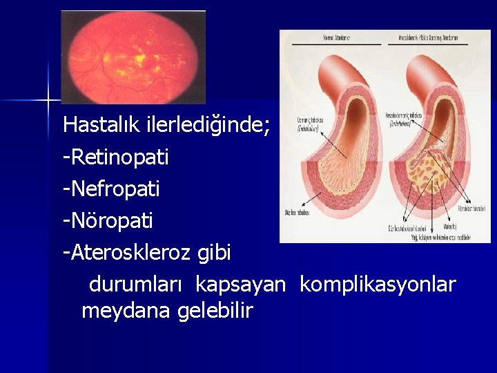 Hastalık ilerlediğinde; -Retinopati -Nefropati -Nöropati -Ateroskleroz gibi durumları kapsayan komplikasyonlar meydana gelebilir 