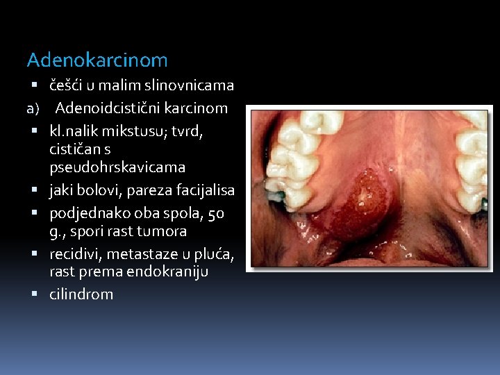 Adenokarcinom češći u malim slinovnicama a) Adenoidcistični karcinom kl. nalik mikstusu; tvrd, cističan s
