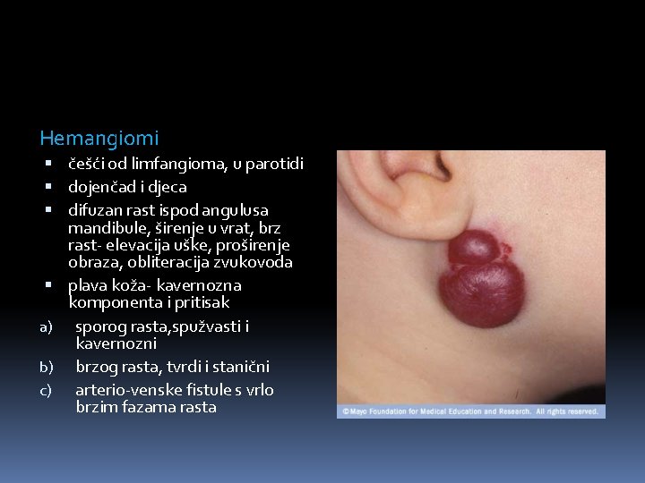 Hemangiomi češći od limfangioma, u parotidi dojenčad i djeca difuzan rast ispod angulusa mandibule,