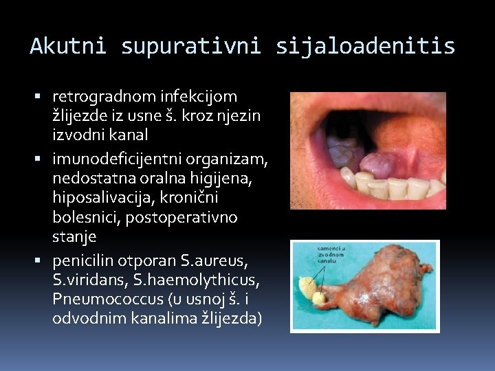 Akutni supurativni sijaloadenitis retrogradnom infekcijom žlijezde iz usne š. kroz njezin izvodni kanal imunodeficijentni